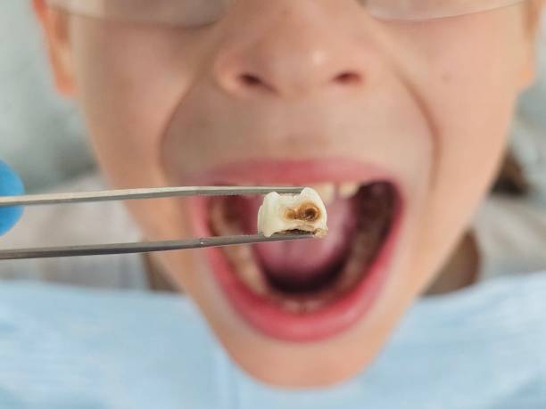 Best Emergency Treatment for Dental Infections or Abscesses in Pittsfield, IL